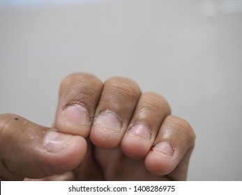 Close Up Shot Of Bad Behavior Or Habit Of Biting Nails. Refer As Stress, Anxiety, Worry And Health Issue. All Fingernails Are Bitten And Pinky Nail Is Bleeding