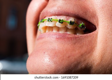 Close Up Shot Of A Crooked Overbite Teeth With Braces