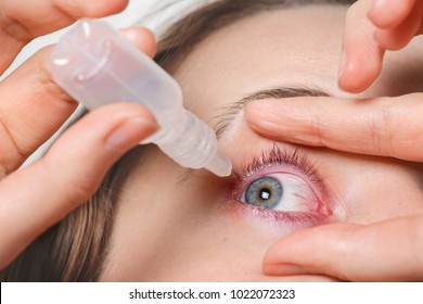 Close Up Shot Of Female Pours Drops In Red Eye, Has Conjuctivitis Or Glaucoma, Bad Eyesight And Pain. Eyes Pain Treatment Concept. Woman Cures Red Blood Eye