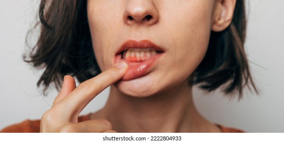 Close up shot of gum inflammation. Cropped shot of a young woman showing red bleeding gums isolated on a gray background. Dentistry, dental care - Shutterstock ID 2222804933