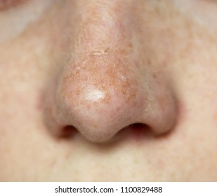 Dry Skin Nose High Res Stock Images Shutterstock