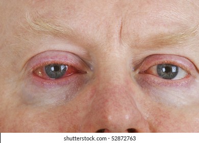 Close up shot from  man's wrinkled tired irritated bloodshot eye.