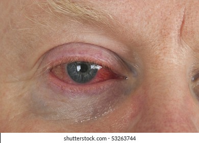 Close up shot from  man's wrinkled tired irritated bloodshot eye.