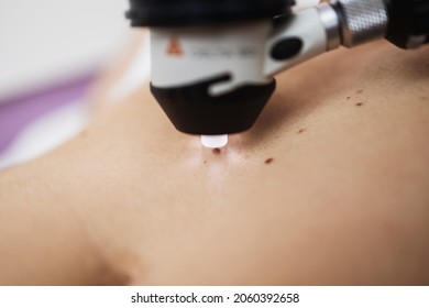 Close Up Shot Of Modern Dermatology Skin Check Up With Digital Deramatoscope. Dermoscopy Microscope Procedure And Skin Cancer Prevention Treatment. 