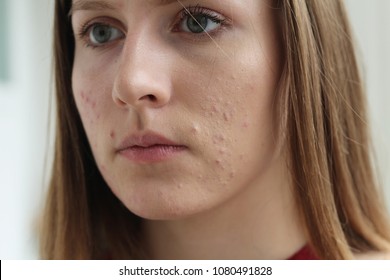 Close shot of a young lady with a typical teenager acne, pimples, scars problem