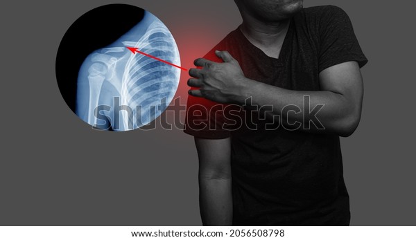 Close up Shoulder and clavicle\
fracture pain in a man, Young man holding his shoulder in pain\
Shoulder inflammation symptoms medical healthcare\
concept.\

