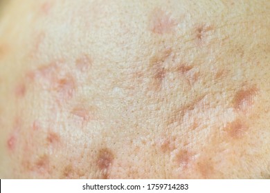 Close Up Of A Skin With Fresh Acne Scars And Clogged Pores