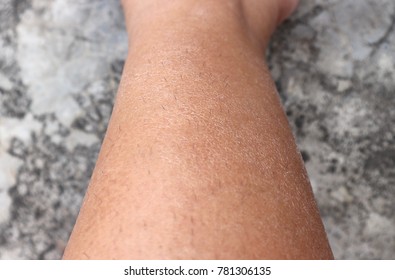 Closeup Dried Rash Allergic Contact Dermatitis Stock Photo 1748492327 ...