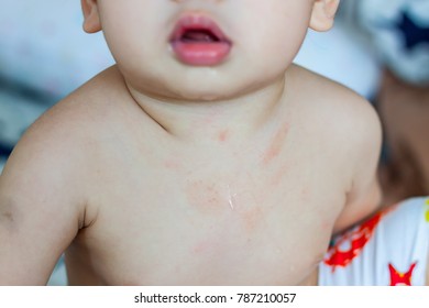 Close Up Skin Rashes On Body Newborn Baby Boy.