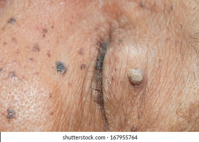 Close Up Of Skin Tag Of Left Upper Eyelid.