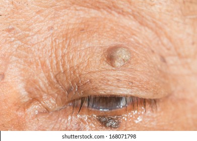 Close Up Of Skin Tag Of Left Upper Eyelid.