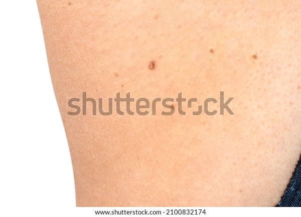 Close up Skin tags\
from under armpit  in Asian woman middle age. Caused by losing\
collagen in skin texture. Compare skin tags removal before and\
after treatment concept
