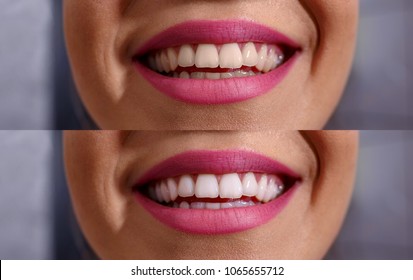 close up of smile with white healthy teeth before and after 