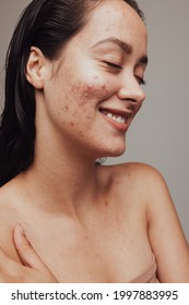 Close up of smiling woman having acne and pimples on face. Young woman smiling with eyes closed despite skin problems.