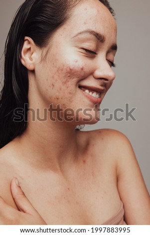 Close up of smiling woman having acne and pimples on face. Young woman smiling with eyes closed despite skin problems.