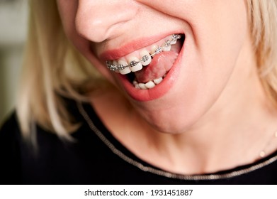 Close up of smiling woman licking white straight teeth with orthodontic brackets. Patient demonstrating results of dental braces treatment. Concept of dentistry, dental care and orthodontic treatment.