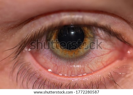A close up of someones eye when its extremely bloodshot from being tired or exhausted 