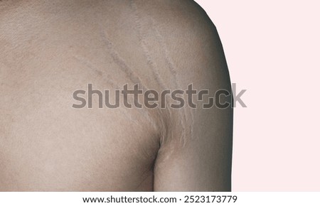 close up stretch marks on man armpit skin area