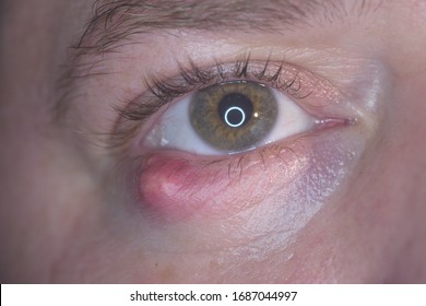 752 Chalazion Images, Stock Photos & Vectors | Shutterstock