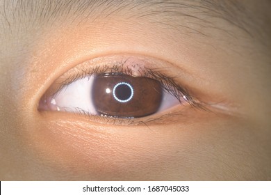 close up of the STYE, HORDEOLUM, CHALAZION, Eyelid infection during eye examination.