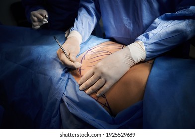 Close Up Surgeon Hands In White Sterile Gloves Using Scalpel, Doing Plastic Surgery In Operating Room. Surgeon Cutting Patient Belly With Blue Marks On Skin. Concept Of Medicine And Abdominoplasty.