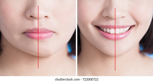 Close Up Of Surgery Woman Asymmetry Chin Before And After On The Blue Background