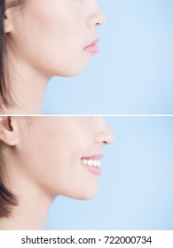 Close Up Of Surgery Woman With Tip Chin Before And After On The Blue Background