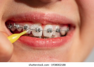 Close up of a teenage girl smiling in orthodontic brackets. Girl with braces on teeth. Orthodontic Treatment.