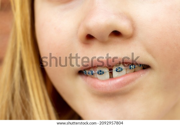 Close up of a teenage girl wearing metal braces.\
Orthodontic dental braces teeth straighteners. Bracket system. A\
gap between front teeth