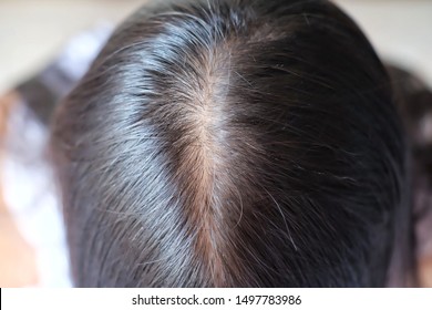 Close Up Thin Hair On Scalp Of Head Woman.