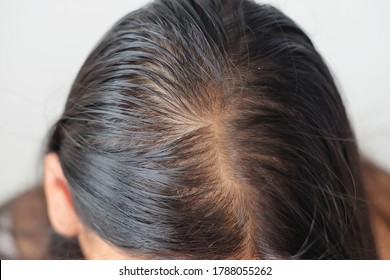 Close Up Thin Hair On Scalp Of Head Woman.