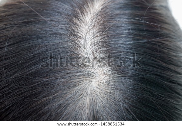 Close Thin Hair On Scalp Head Stock Photo Edit Now 1458851534