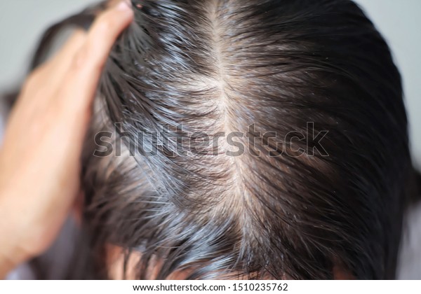Close Thin Hair On Scalp Head Stock Image Download Now
