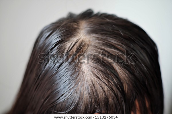 Close Thin Hair On Scalp Head Stock Photo Edit Now 1510276034