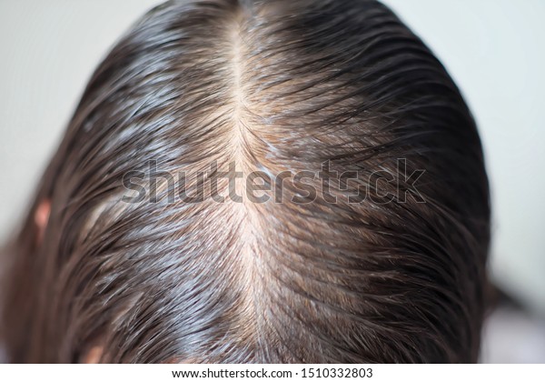 Close Thin Hair On Scalp Head Stock Photo Edit Now 1510332803