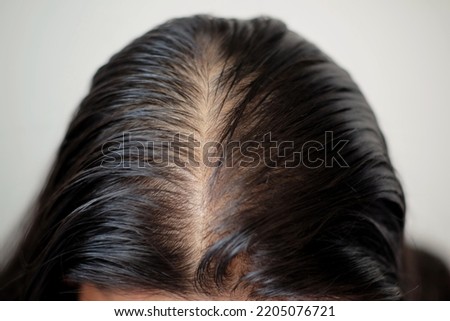 Close up thin hair onscalp of head woman on blur background.