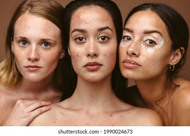 Close up of three strong women having skin problems together on brown background. Young women having diverse skin disorders like freckles, acne and vitiligo.