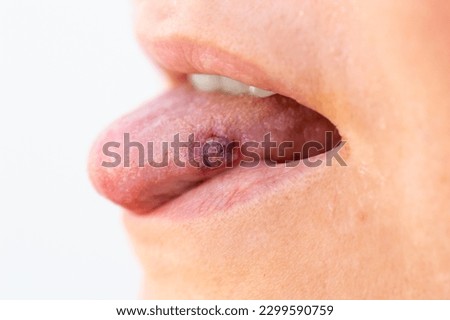 Close up of tongue with ulcers of adult woman