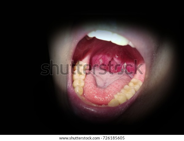 Close Tonsillitis Sick Dentist Light Dark Stock Photo Edit Now 726185605