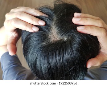 Close up top view head of asian woman with white hair loss and skin problem.