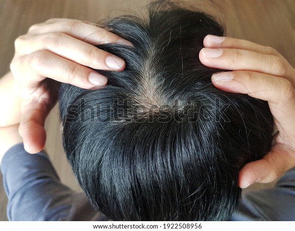 Close up top view head of asian woman with white\
hair loss and skin\
problem.