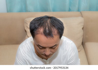 Close Up Top View Of A Man's Head With Hair Transplant Surgery With A Receding Hair Line. -  5 Months After Bald Head Of Hair Loss Treatment.