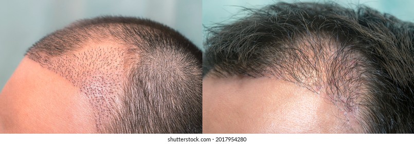 Close Up Top View Of A Man's Head With Hair Transplant Surgery With A Receding Hair Line. -  1-5 Months After Bald Head Of Hair Loss Treatment.