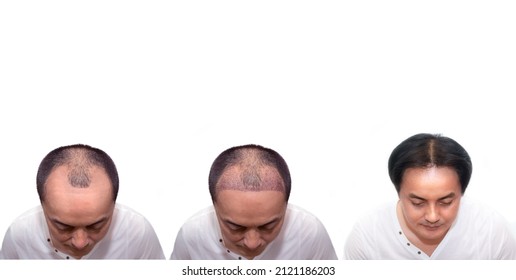 Close Up Top View Of A Man's Head With Hair Transplant Surgery With A Receding Hair Line. Before And After Bald Head Of A Man . After Bald Head Of Hair Loss Treatment On White Background