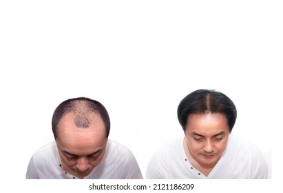 Close Up Top View Of A Man's Head With Hair Transplant Surgery With A Receding Hair Line. Before And After Bald Head Of A Man . After Bald Head Of Hair Loss Treatment On White Background