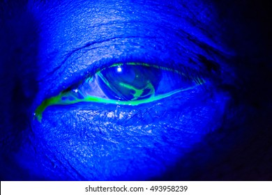 82 Corneal Abrasion Images, Stock Photos & Vectors | Shutterstock