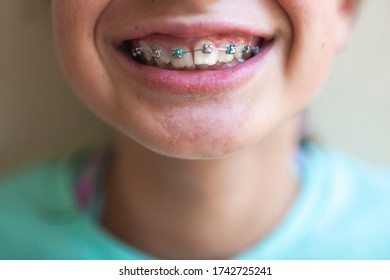 Close up of Tween girls mouth after getting braces