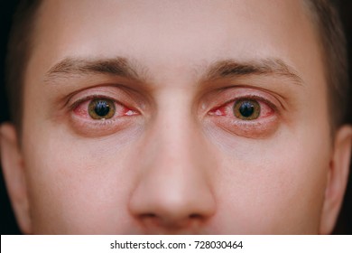 Close up of two annoyed red blood eyes of male affected by conjunctivitis or after flu, cold or allergy. Concept of health, disease and treatment. Copy space for advertisement. With place for text.