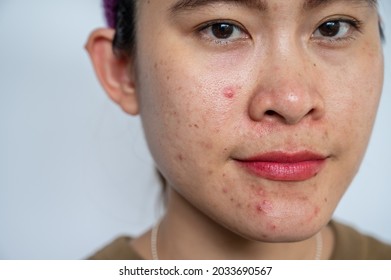 Close Up Of Ugly Asian Woman Having Acne Inflamed On Her Face. Inflamed Acne Consists Of Swelling, Redness, And Pores That Are Deeply Clogged With Bacteria, Oil, And Dead Skin Cells.