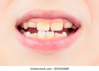 Close Up Of Unhealthy Baby Teeths. Kid Patient Open Mouth Showing Cavities Teeth Decay. Bad Teeth Child. Portrait Boy With Bad Teeth. Child Smile And Show Her Crowding Tooth.